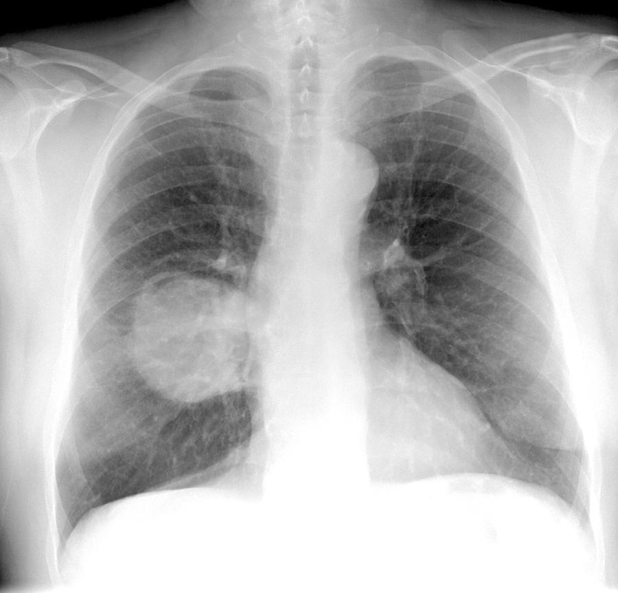 Lung Cancer, Xray Photograph by Du Cane Medical Imaging Ltd