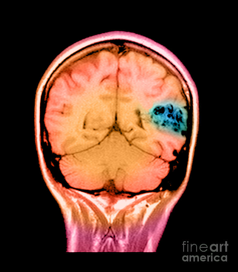 Abnormal Mri Brain Photograph - Mri Of Brain Avm #14 by Medical Body Scans