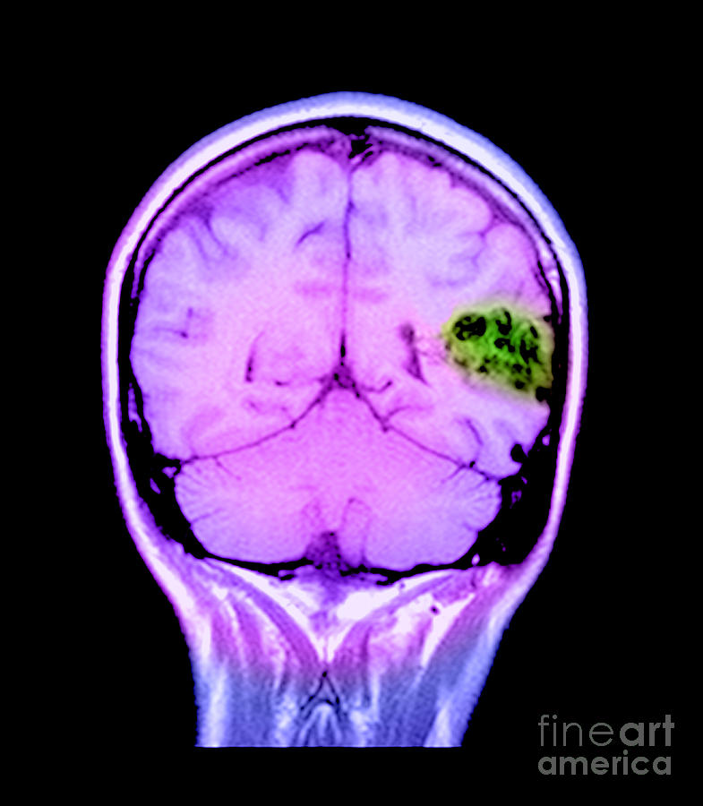 Mri Of Brain Avm #15  by Medical Body Scans