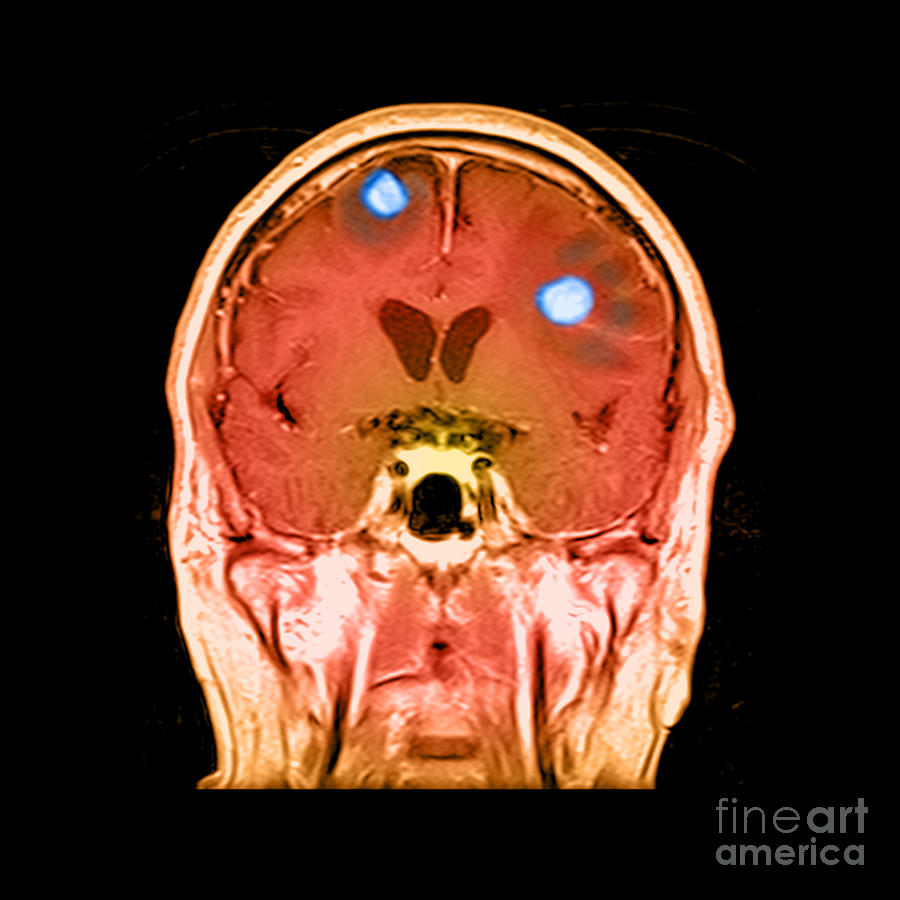 Brain Tumors #17 Photograph by Medical Body Scans