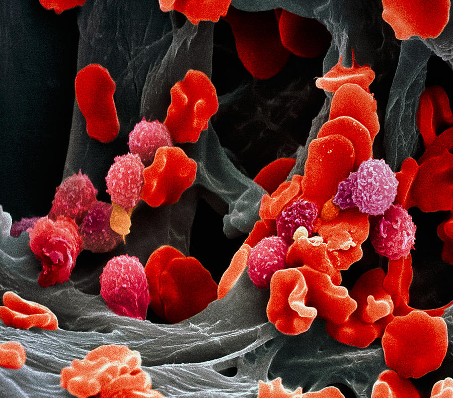 Images Photograph - Leukaemia Blood Cells, Sem #19 by Steve Gschmeissner
