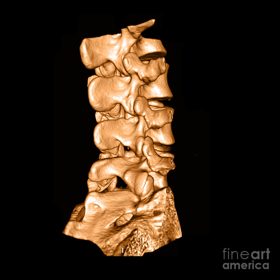 3d Ct Of Lumbar Spine #2 Photograph by Medical Body Scans