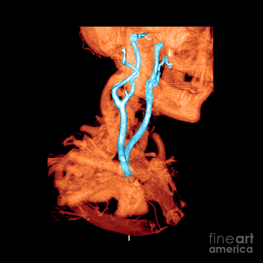 3d Cta Of Carotid Arteries #2 Photograph by Medical Body Scans