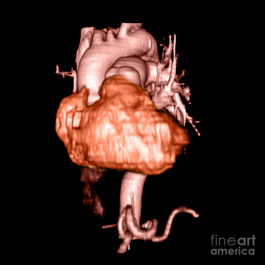 3d Cta Of Heart #2 Photograph by Medical Body Scans