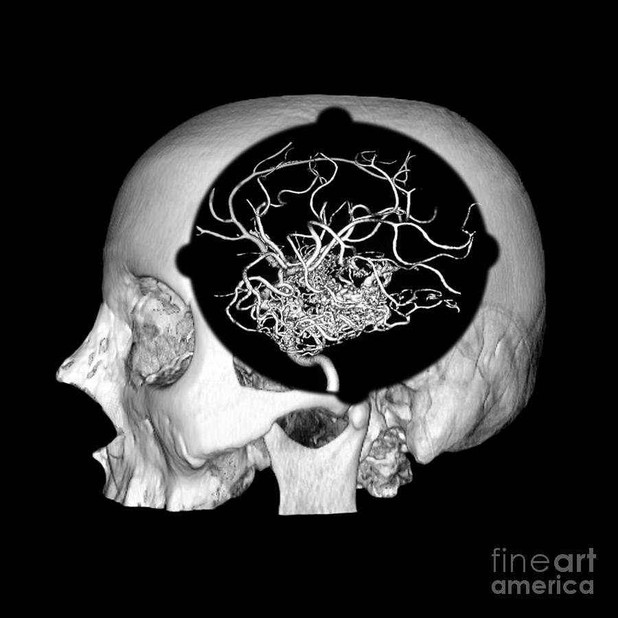 3d Image Of Skull And Brain Avm #2 Photograph by Medical Body Scans