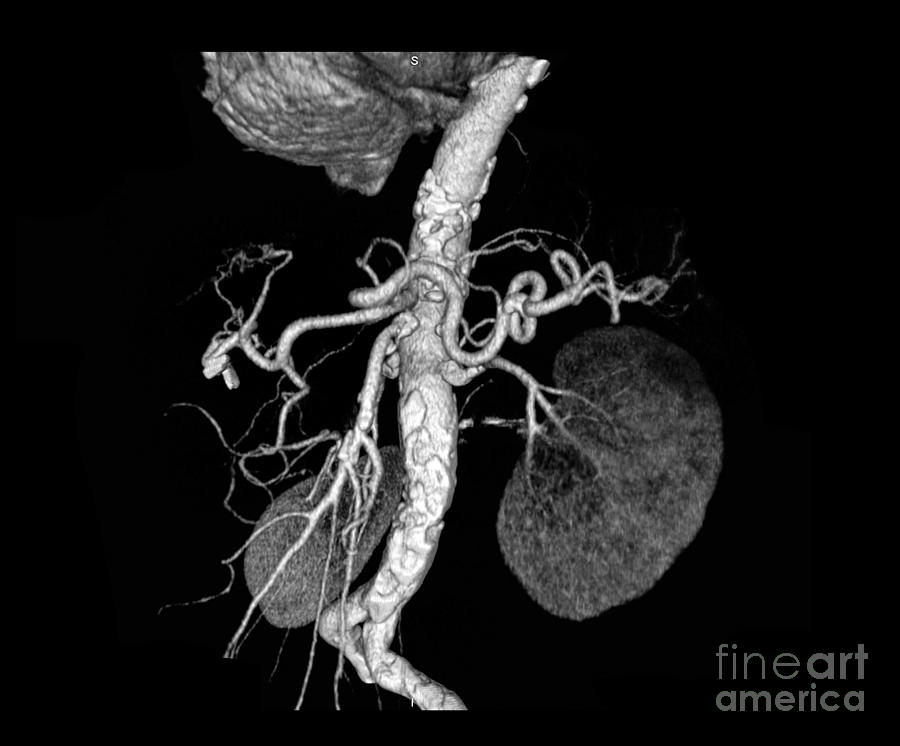Abdominal Aorta #2 Photograph by Medical Body Scans