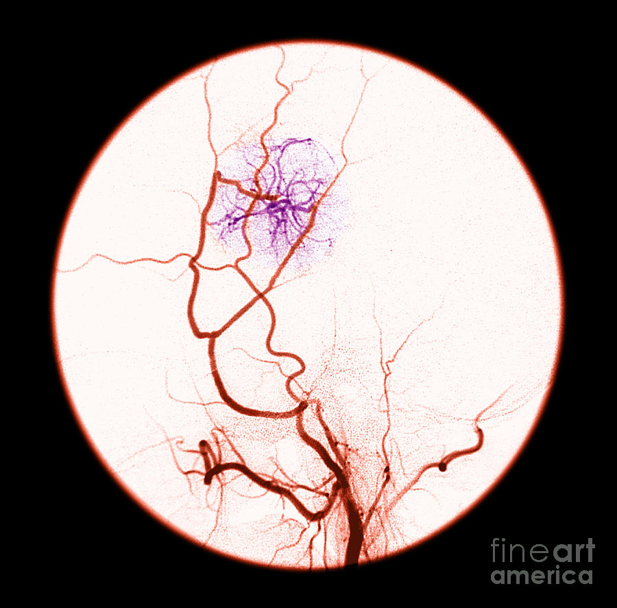 Abnormal Blood Flow #2 Photograph by Medical Body Scans
