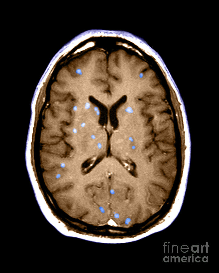 Abnormal Mri Of Brain #2 Photograph by Medical Body Scans