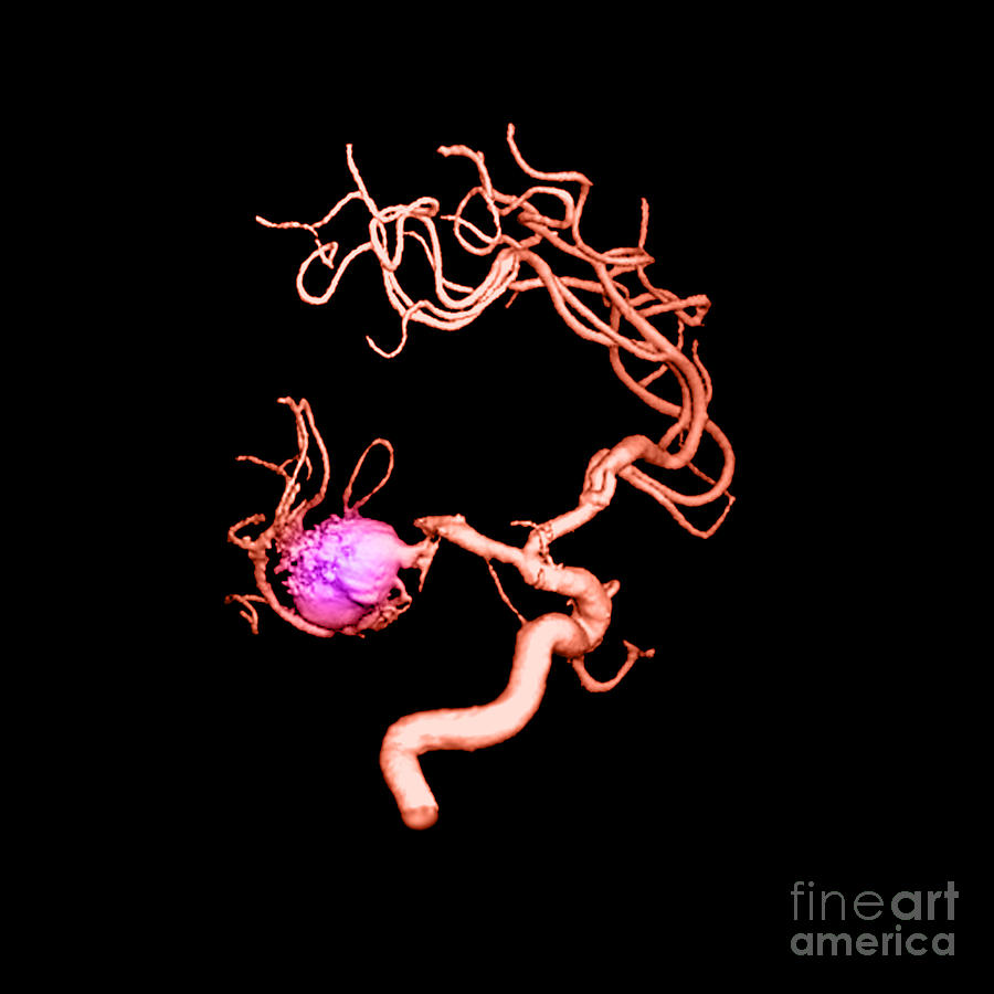 Aneurysm In The Human Brain #2 Photograph by Medical Body Scans