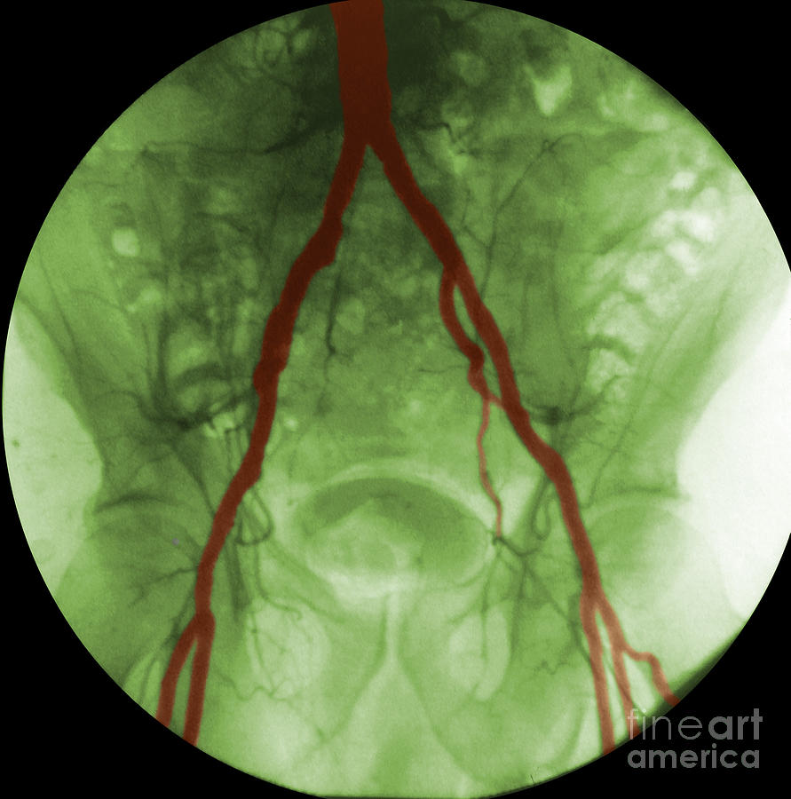 Angiogram Of Iliac Arteries #2 Photograph by Omikron