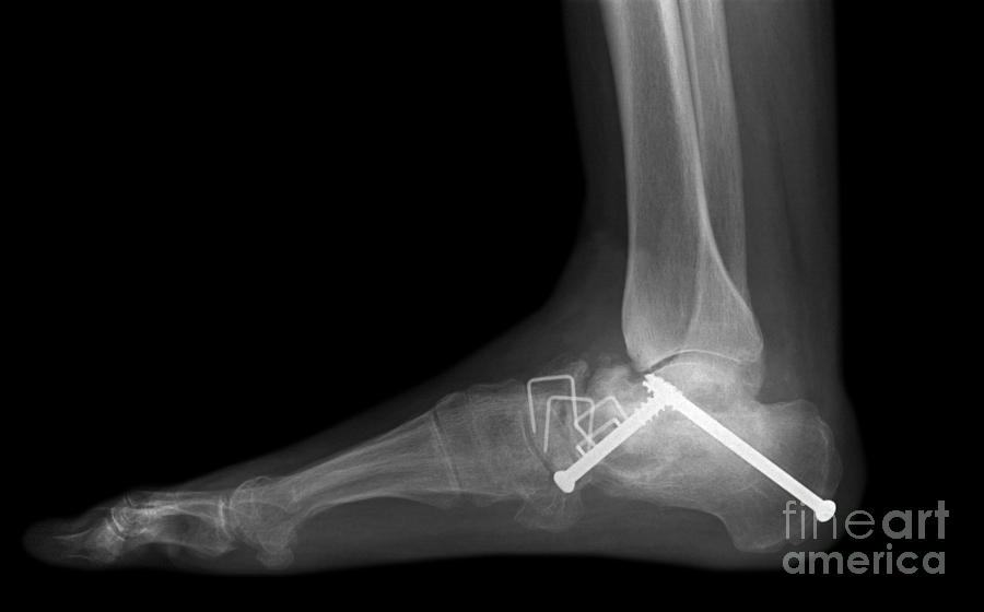 Ankle Fracture #2 Photograph by Ted Kinsman