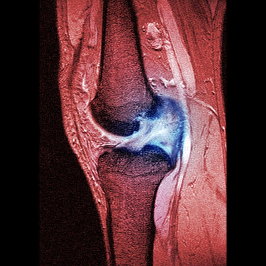 Anterior Cruciate Ligament Photograph - Anterior Cruciate Ligament Tear, Ct Scan #2 by Du Cane Medical Imaging Ltd