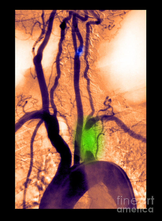 Aortic Arch Angiogram #2 Photograph by Medical Body Scans