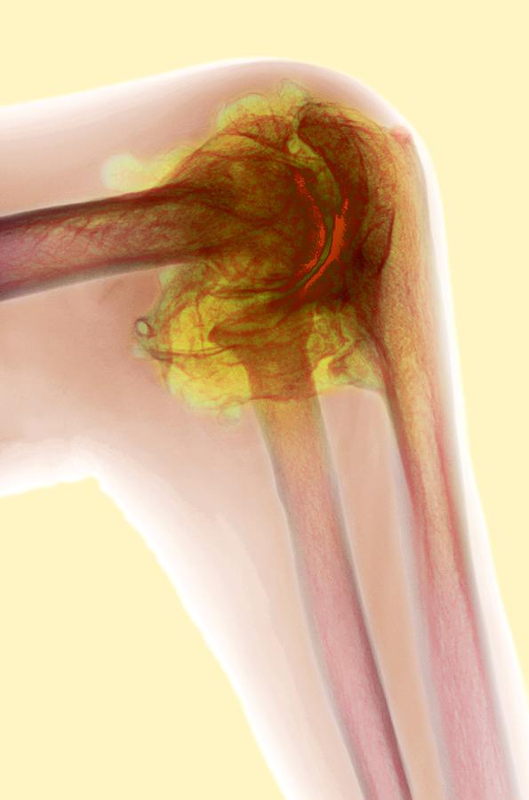 Elbow Photograph - Arthritic Elbow, X-ray #2 by Du Cane Medical Imaging Ltd