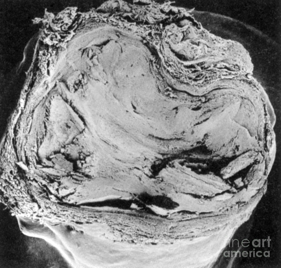 Atherosclerosis Sem, Full Blockage #2 Photograph by Science Source