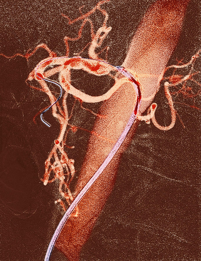  Balloon Angioplasty  X ray Photograph by Du Cane Medical 