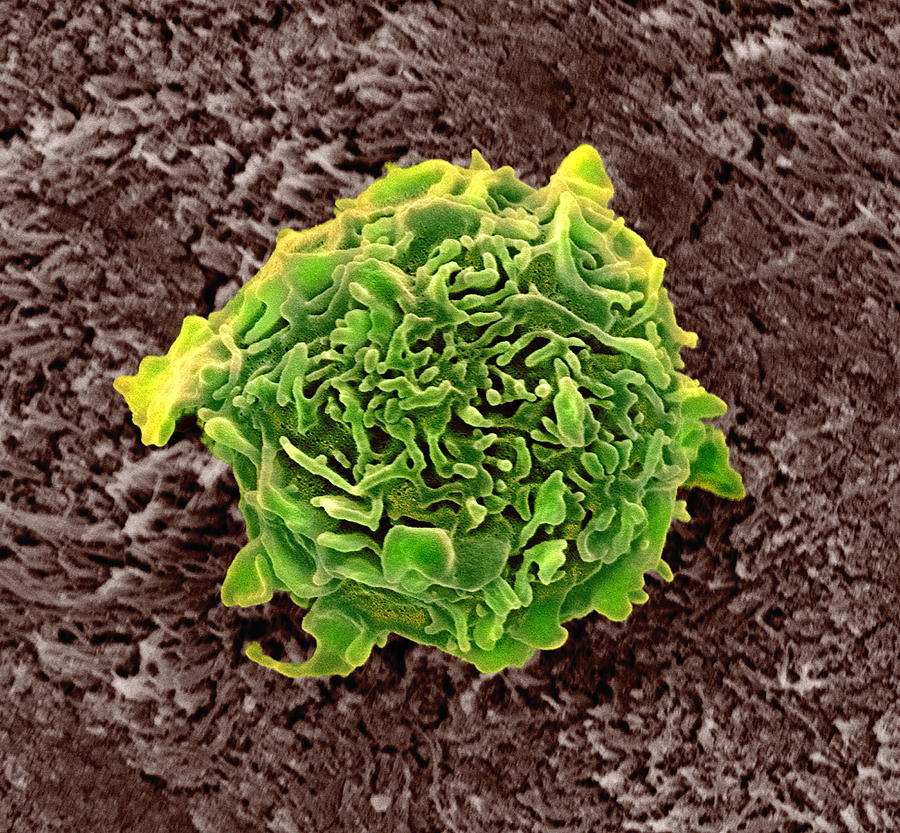 bone-cancer-cell-sem-photograph-by-steve-gschmeissner-fine-art-america