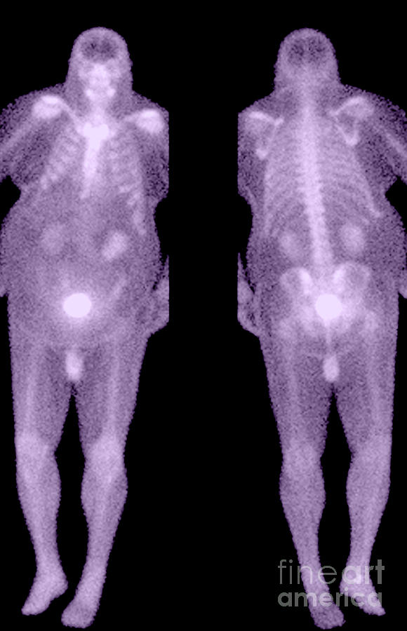 Bone Scan #2 Photograph by Medical Body Scans