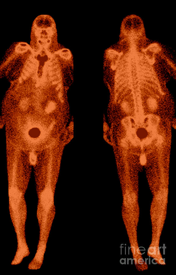 Bone Scans #2 Photograph by Medical Body Scans