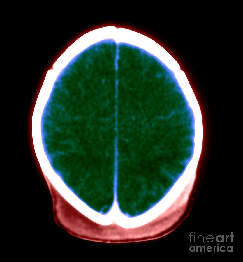 Brain Damage From Lack Of Oxygen #2 Photograph by Medical Body Scans
