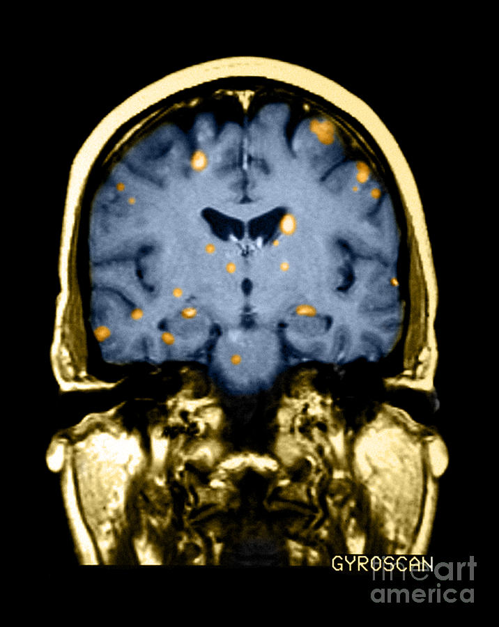Brain Metastasis From Breast Cancer #2 Photograph by Medical Body Scans