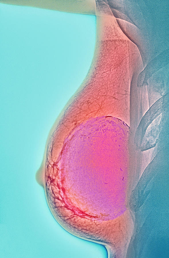Breast Implant Calcification, X-ray #2 Photograph by Cnri