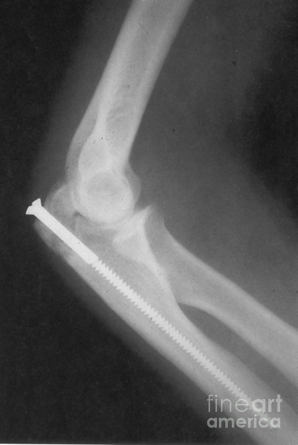 Broken Arm With Metal Pin, X-ray #2 Photograph by Science Source