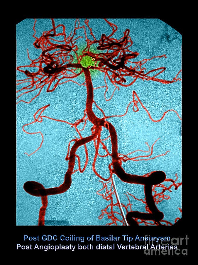 Cerebral Angiogram #2 Photograph by Medical Body Scans