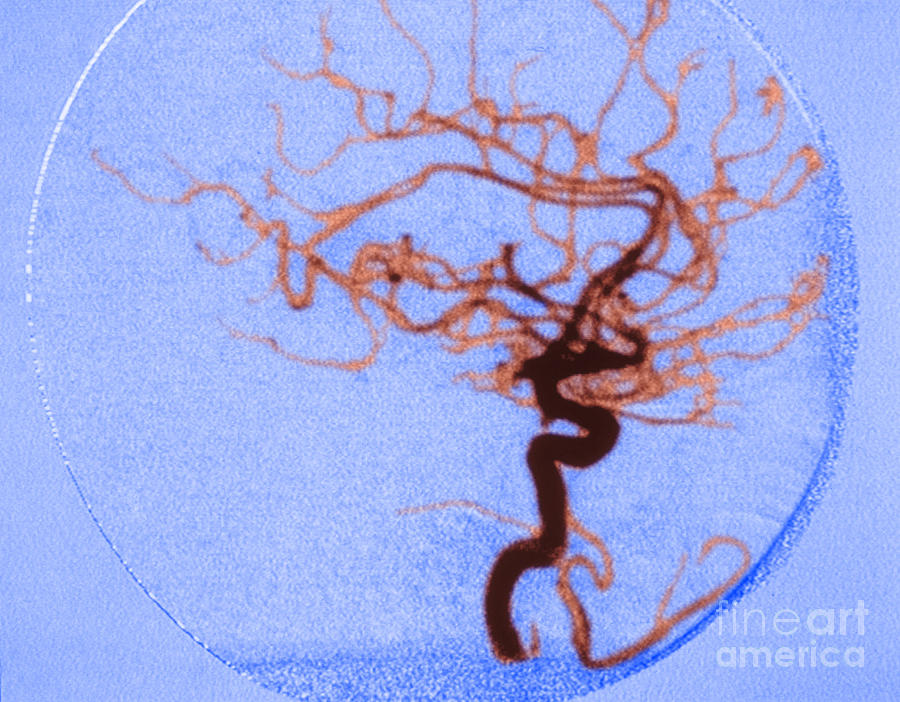 Cerebral Angiogram #2 Photograph by Science Source