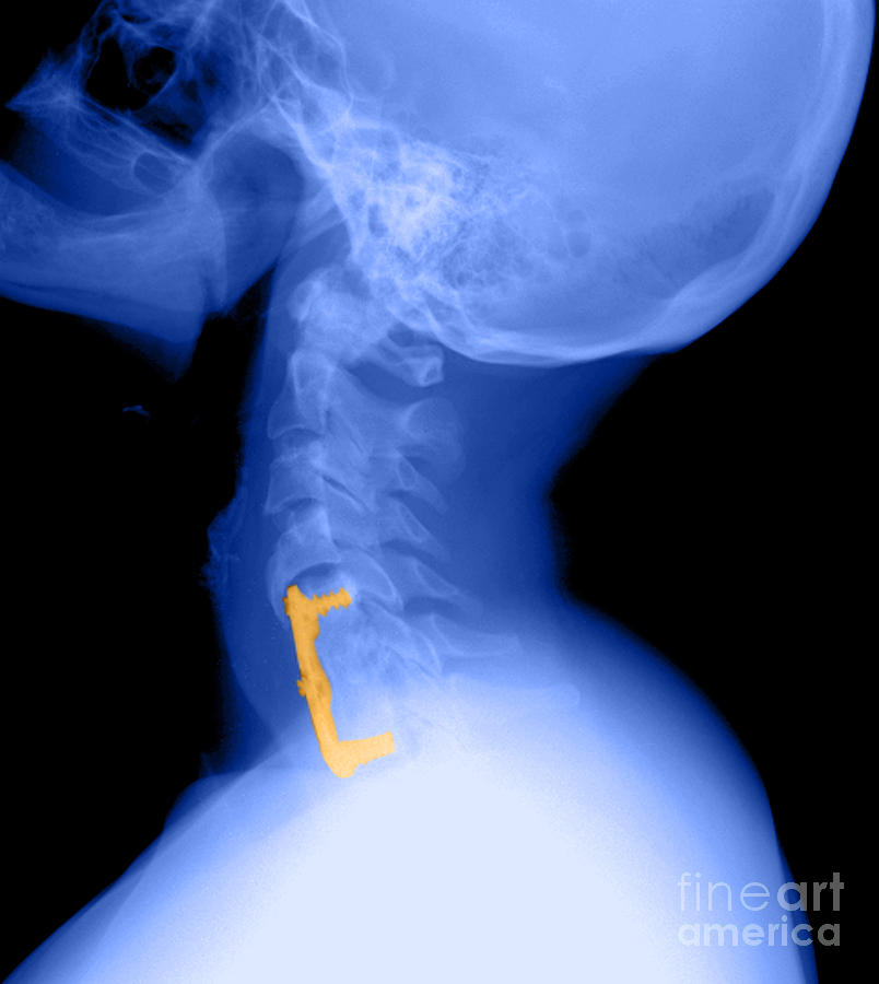 https://images.fineartamerica.com/images-medium-large/2-cervical-spine-medical-body-scans.jpg