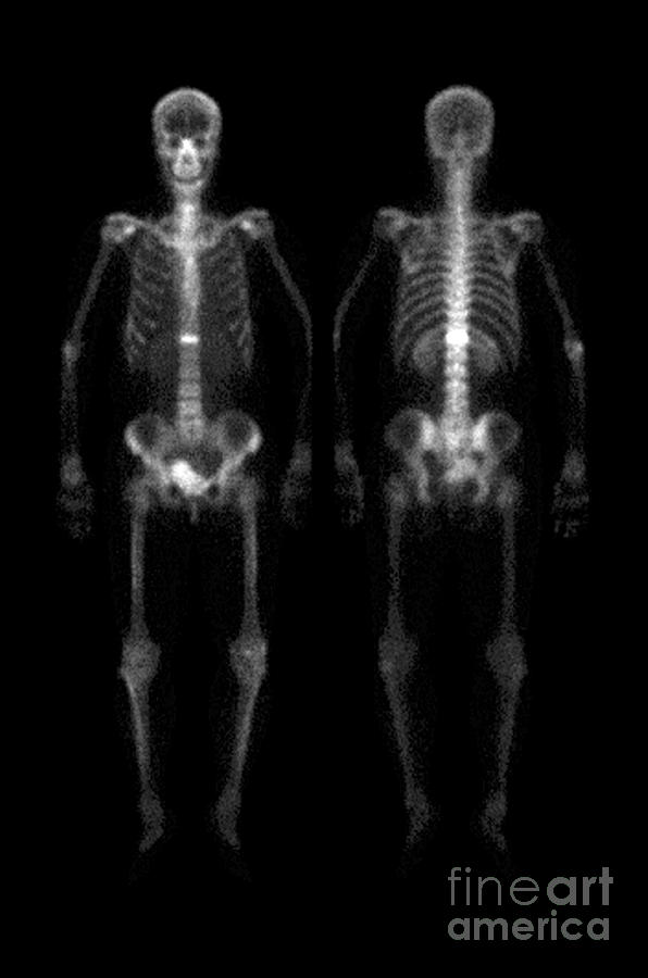 Compression Fracture #2 Photograph by Medical Body Scans