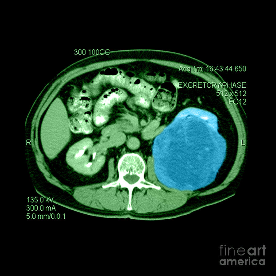 Ct Of Abdomen, Large Renal Carcinoma #2 Photograph by Medical Body Scans