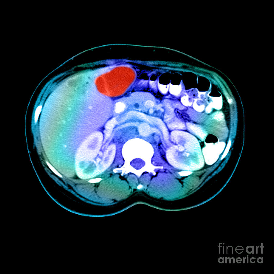 Ct Scan Of A Liver Tumor #2 Photograph by Medical Body Scans