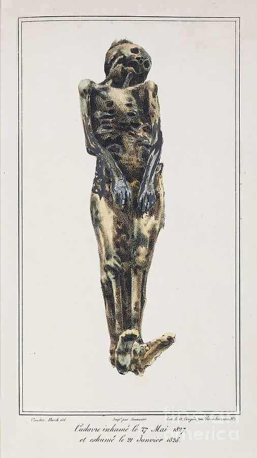 Decomposition On Exhumed Bodies, 1831 #2 Photograph by Science Source