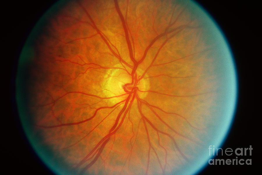Diabetic Retinopathy #2 Photograph by Science Source
