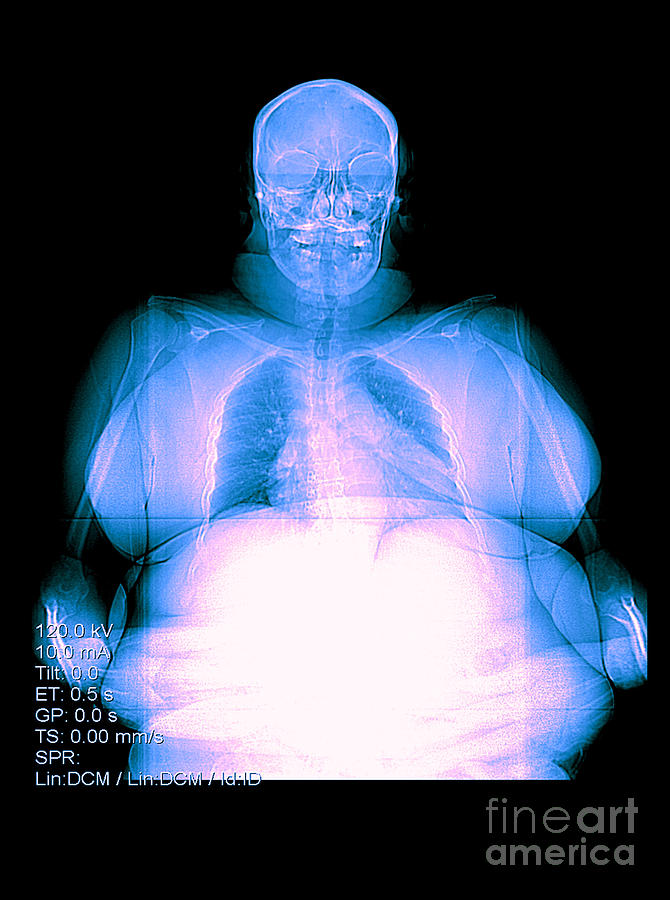 Digital X-ray Of Obesity #2 Photograph by Medical Body Scans