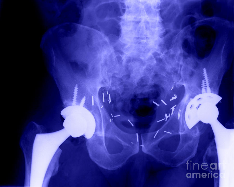 Double Hip Replacement #2 Photograph by Ted Kinsman