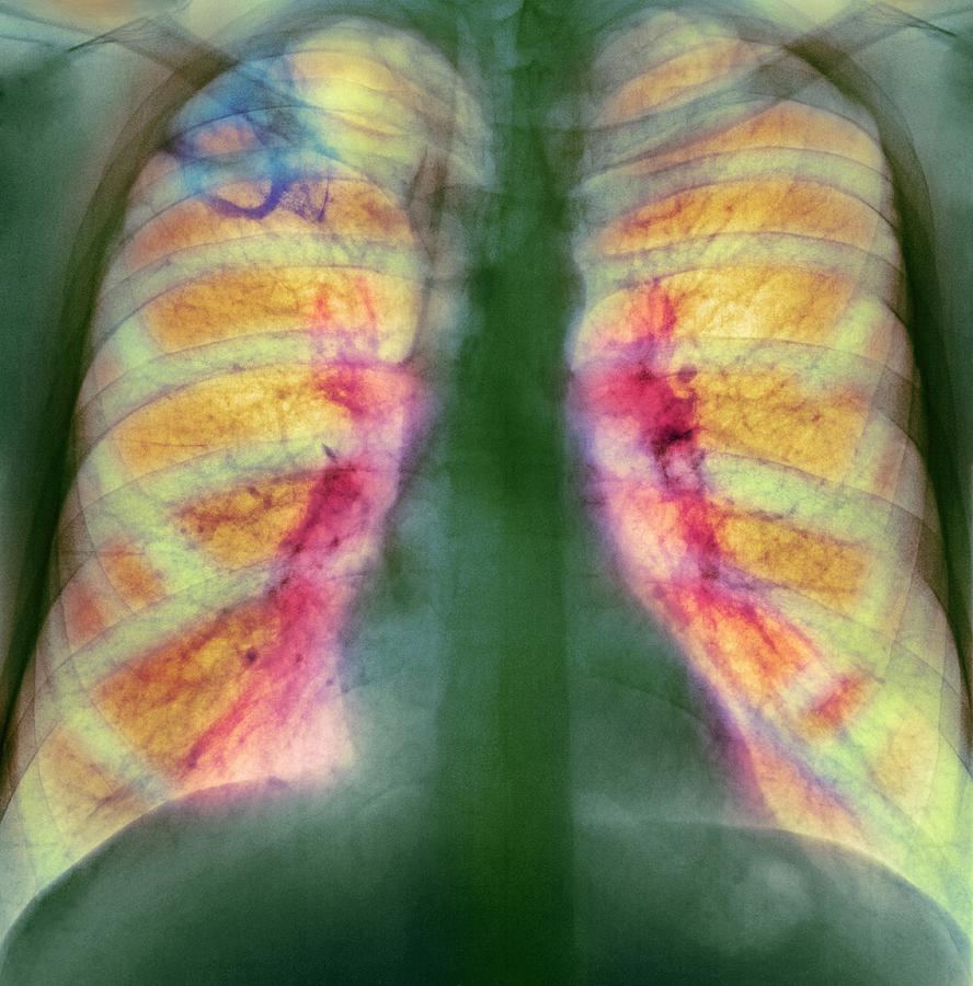 Drug Use Lung Damage, X-ray Photograph by - Fine Art America