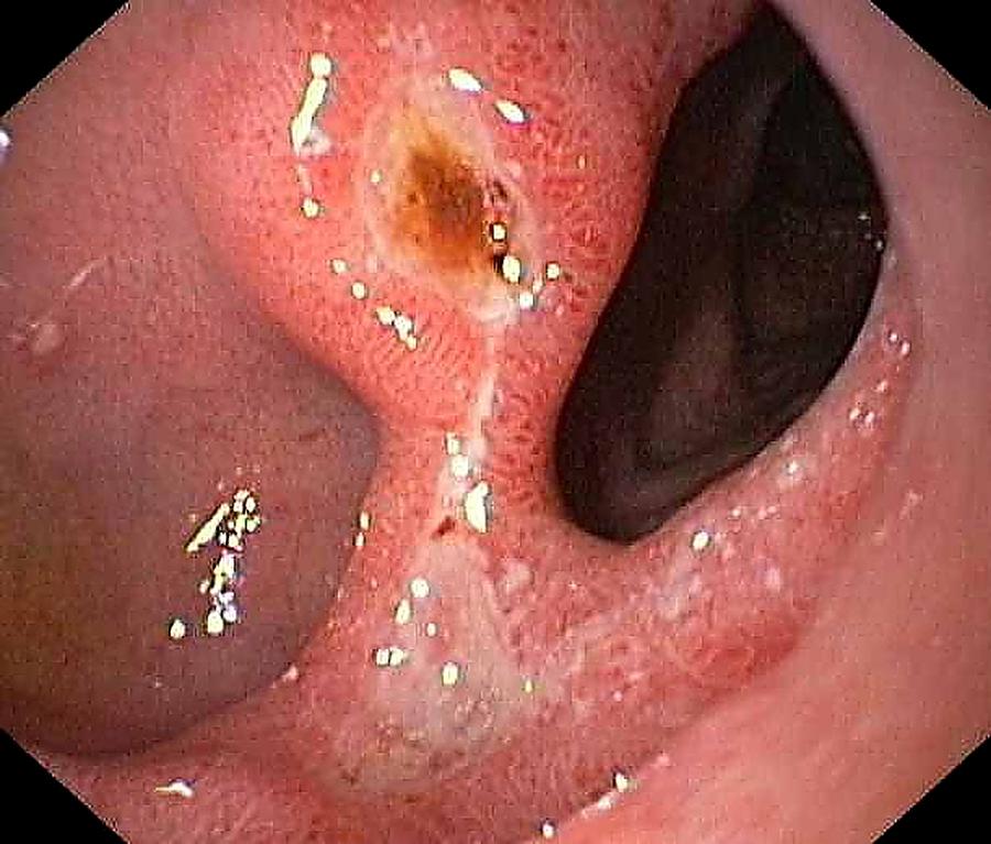 Endoscopy Photograph - Duodenal Ulcer #2 by Gastrolab