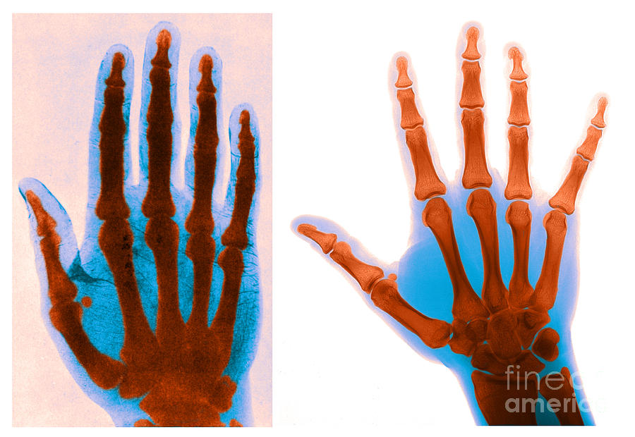Early And Modern Hand X-rays #4 Photograph by Medical Body Scans