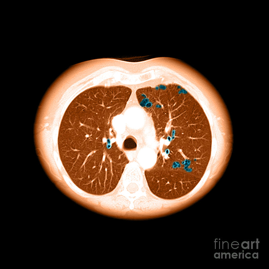 Emphysema On Ct Chest #2 Photograph by Medical Body Scans Emphysema On Ct Chest #2 Photograph by Medical Body Scans