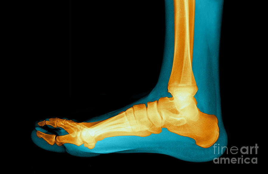 Flat Foot #2 Photograph by Medical Body Scans