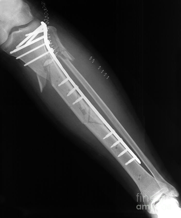 Fractured Tibia #2 Photograph by Ted Kinsman