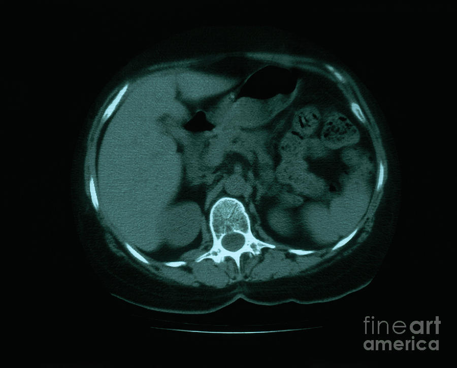 Granuloma & Calcification In Lung Photograph by Science Source | Fine ...