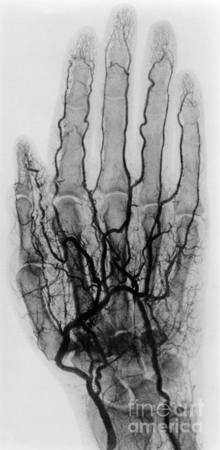 Hand Arteriogram #5 Photograph by Science Source