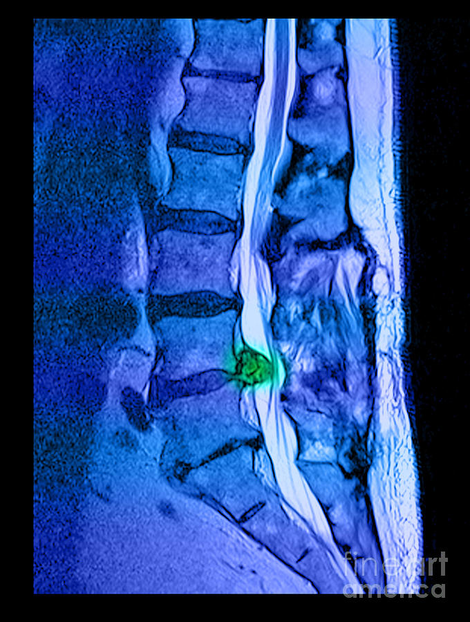 Herniated Disc #2 Photograph by Medical Body Scans
