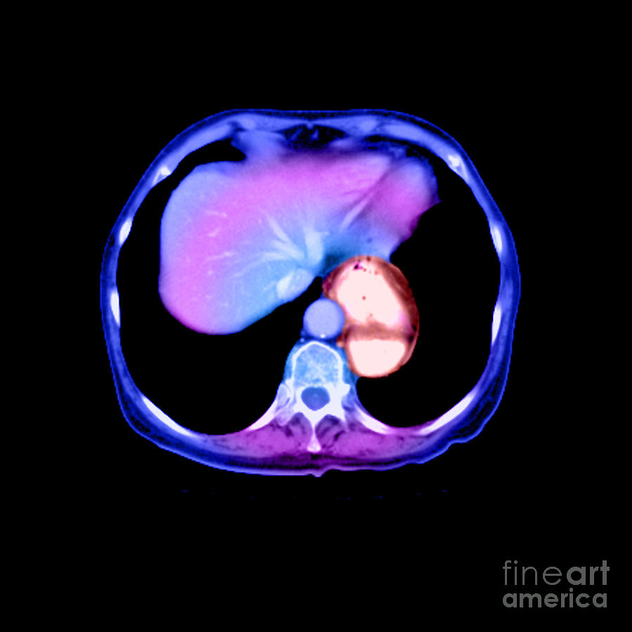 Hiatal Hernia #2 Photograph by Medical Body Scans