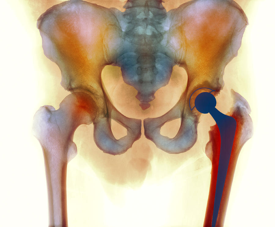 Hip Joint Replacement Photograph - Hip Joint Replacement, X-ray #2 by 