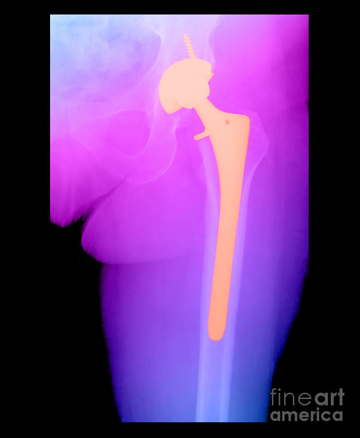 Hip Replacement #2 Photograph by Medical Body Scans