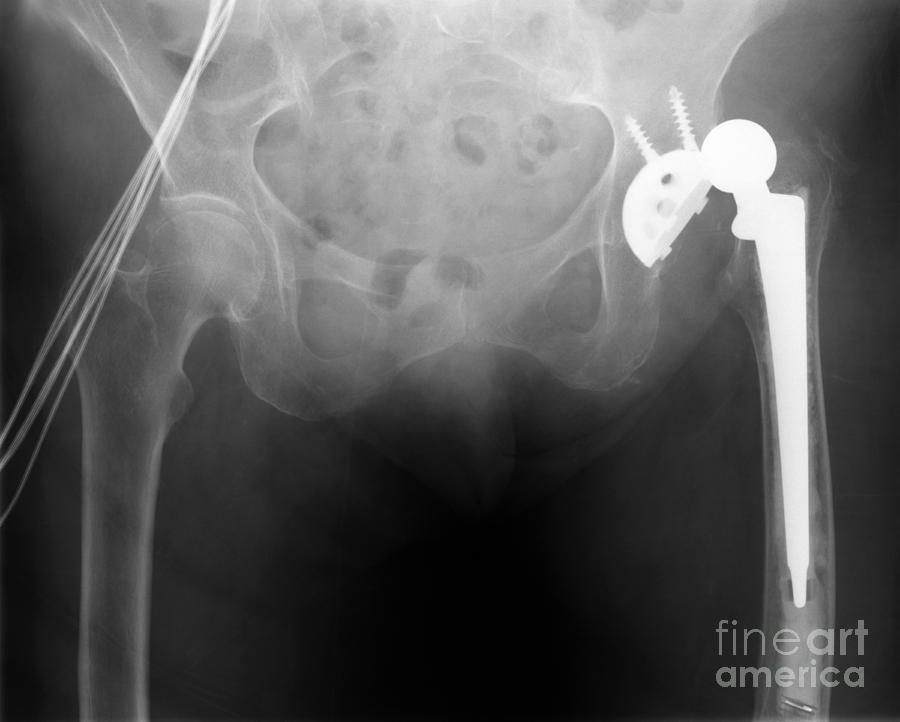 Hip Replacement #2 Photograph by Ted Kinsman